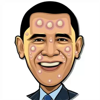 สตาร์บีบสิว